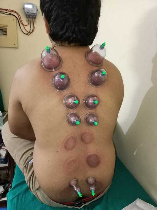 Cupping-Therapy-at-Gurugram-by-Dr.-Hari-om-Vashishtha